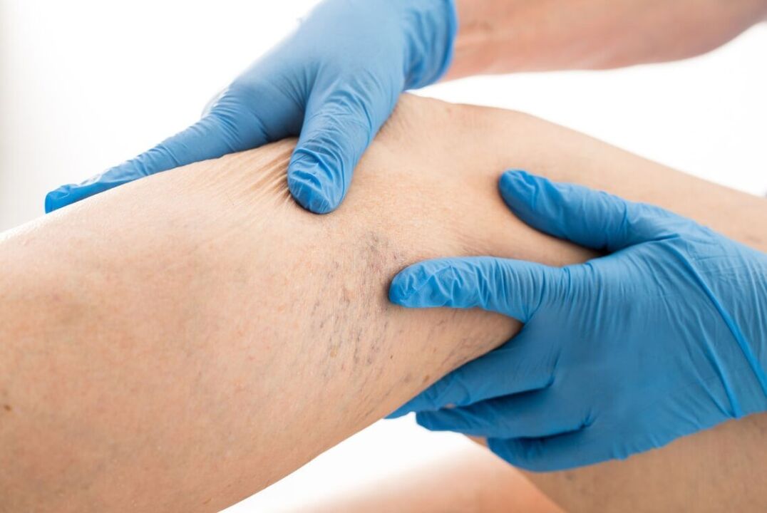 Klinické onemocnění varikázy v klinickém kartánu