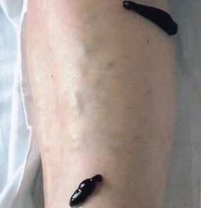 Hirudoterapie jako způsob léčby křečových žil